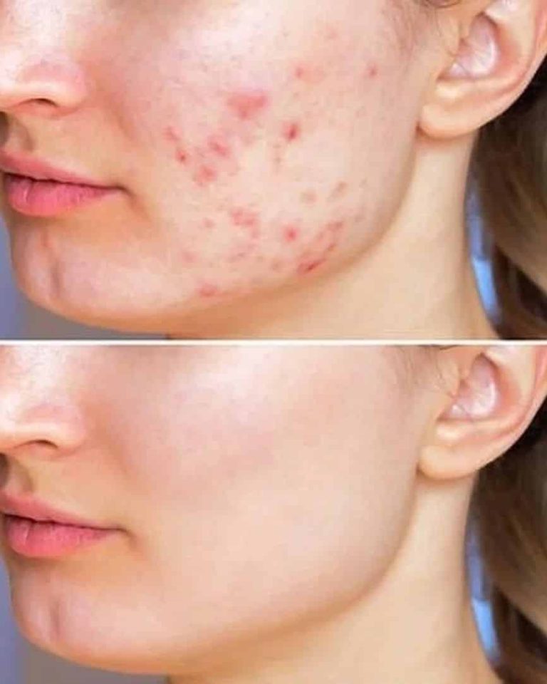 پکهای ضد جوش سالیسیلیک اسید